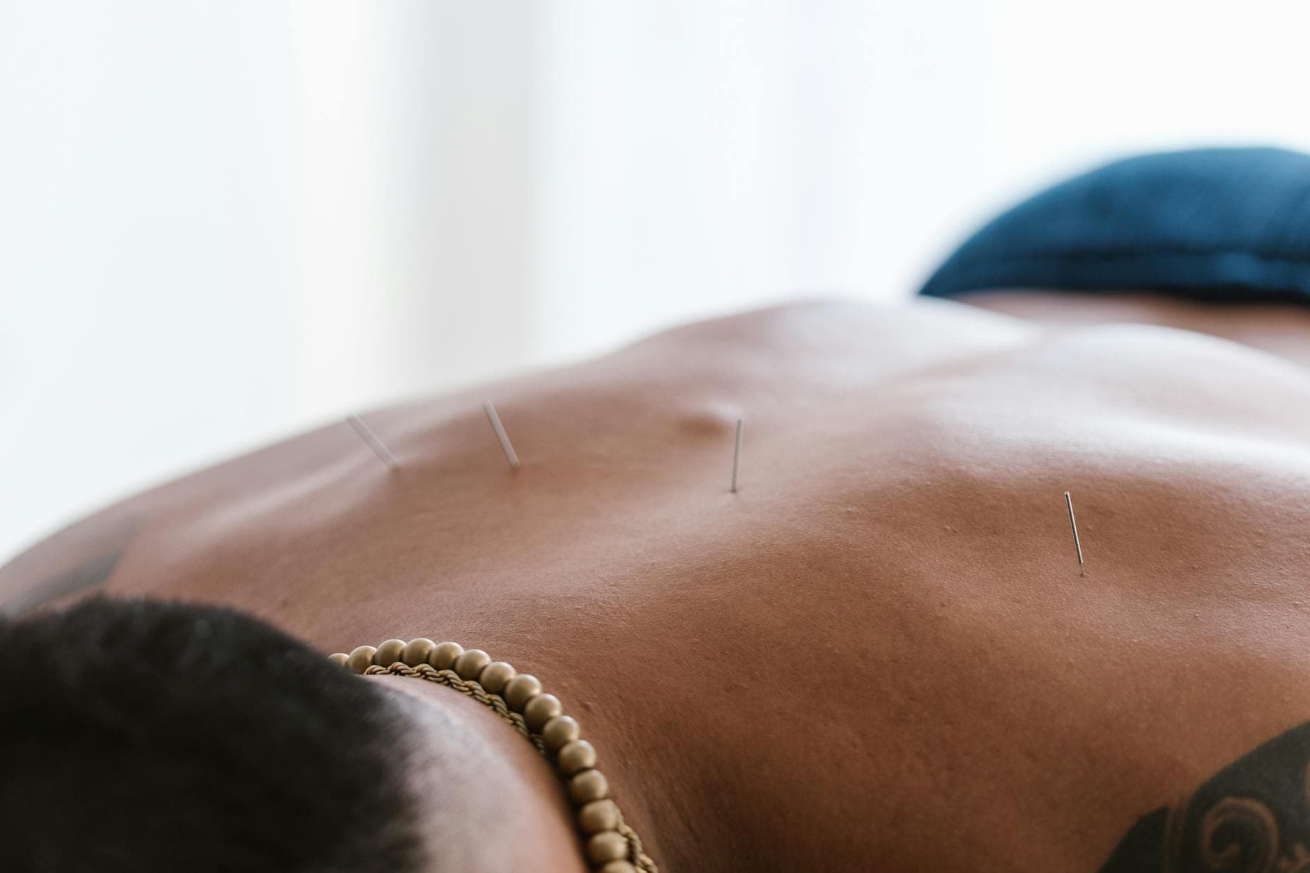 Acupuncture treatment in a calm wellness studio